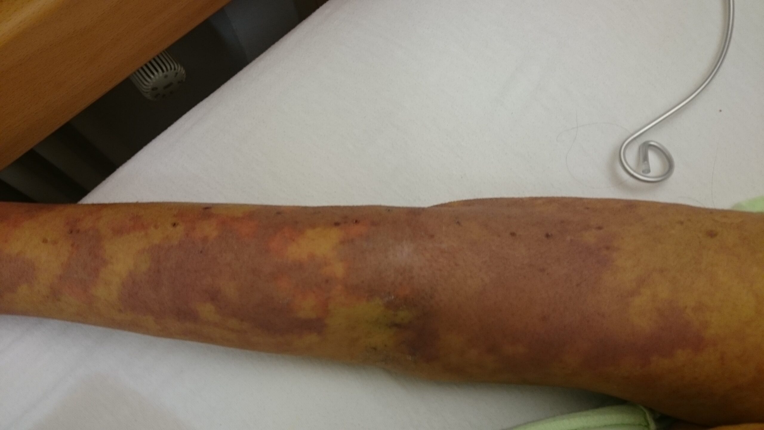 Sepsis-Mikrothomben1-scaled