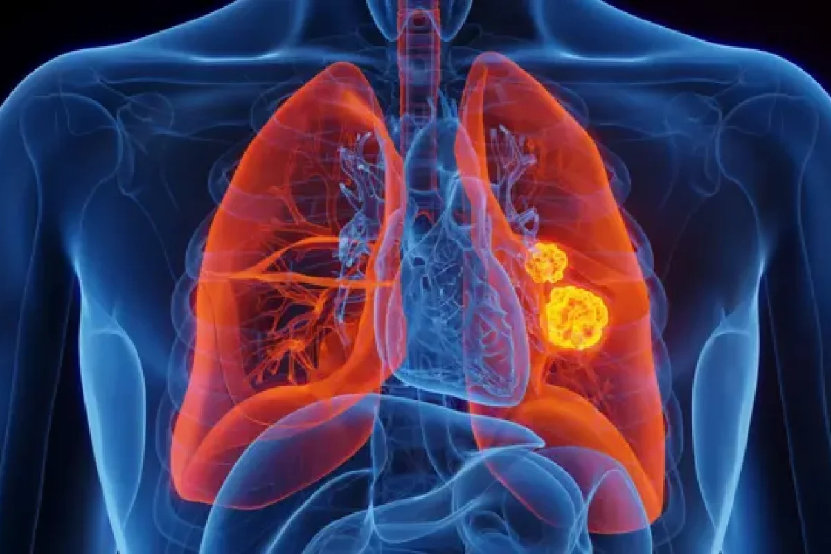 lung-cancer-knowexact